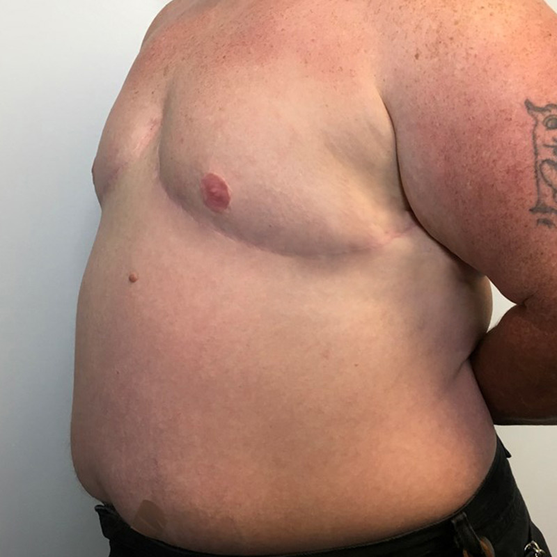 Female To Male Top Surgery 07