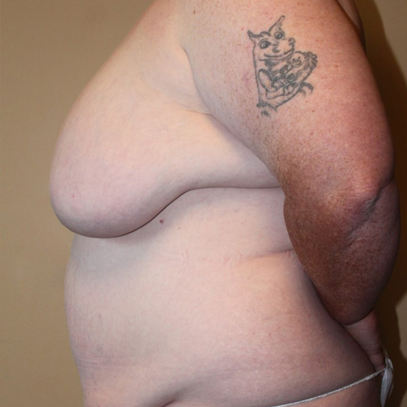 Female To Male Top Surgery 09