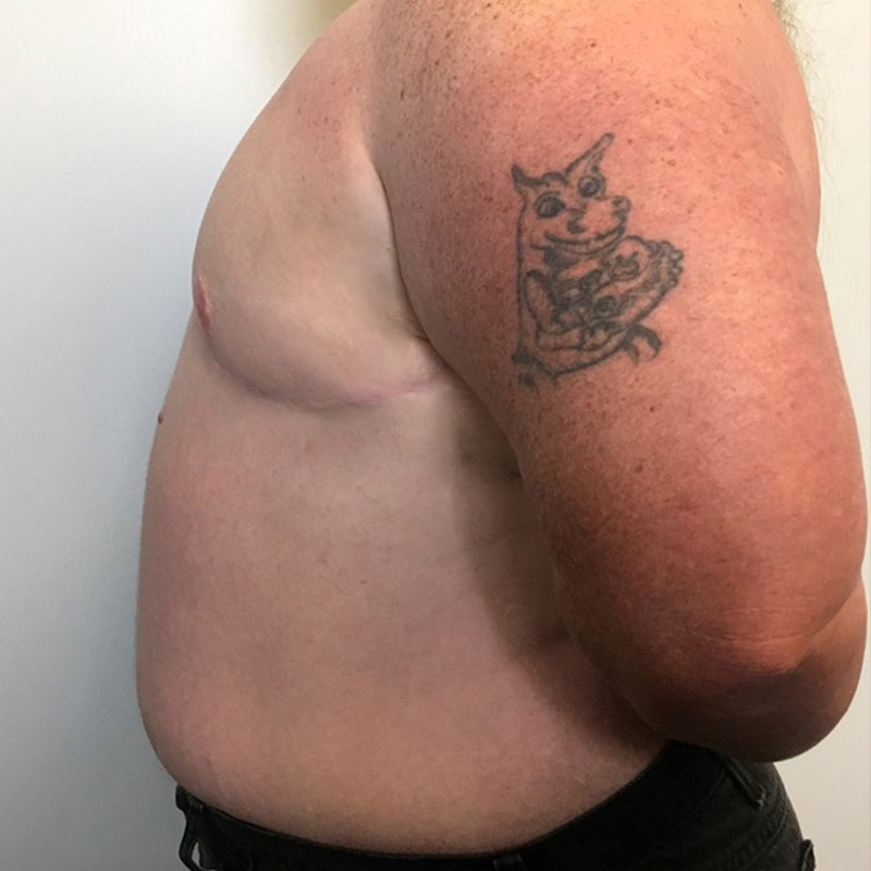 Female To Male Top Surgery 09