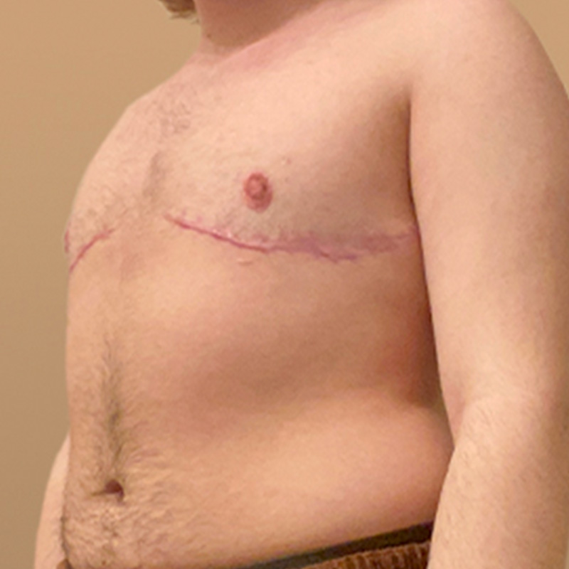 Female To Male Top Surgery 03