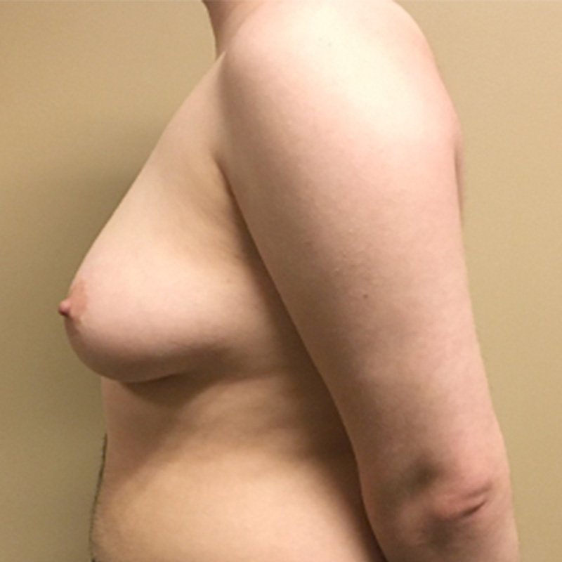 Female To Male Top Surgery 05