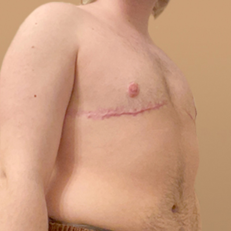 Female To Male Top Surgery 07