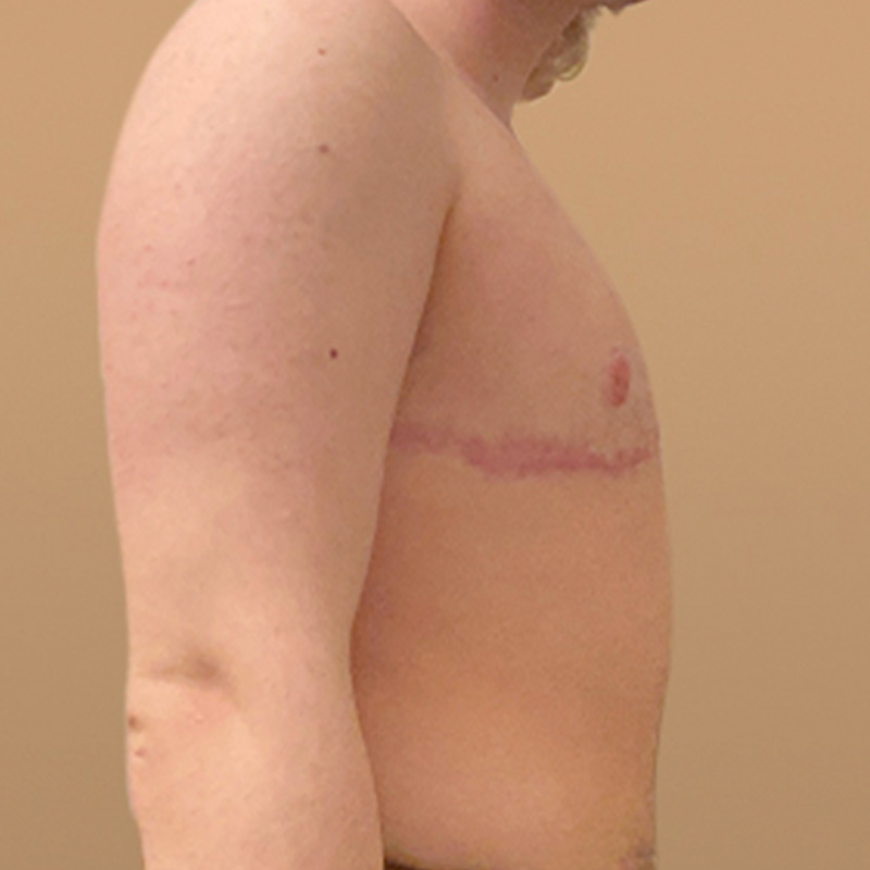 Female To Male Top Surgery 09