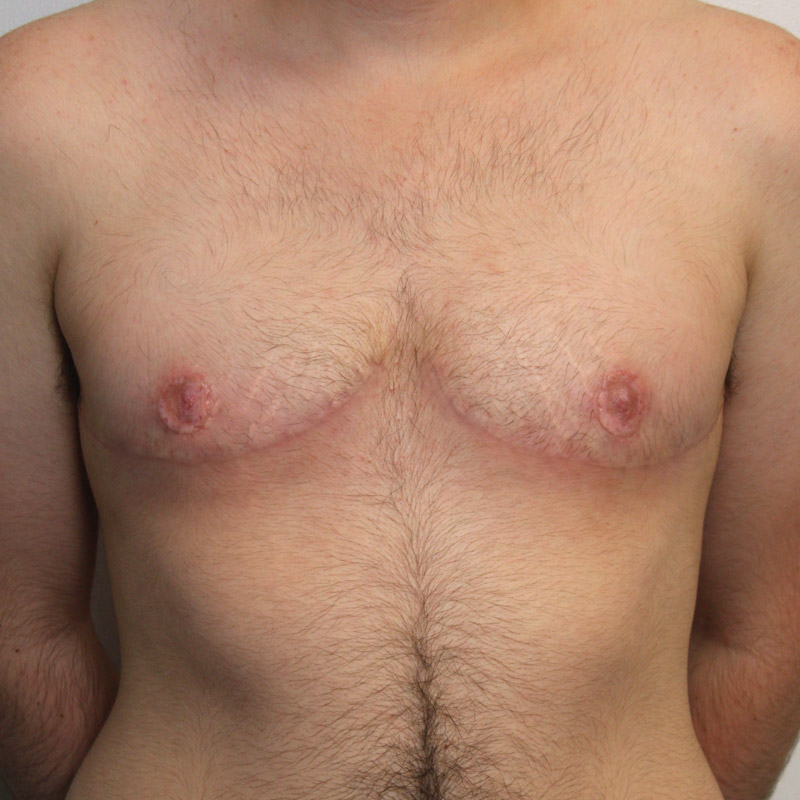 Female To Male Top Surgery 38