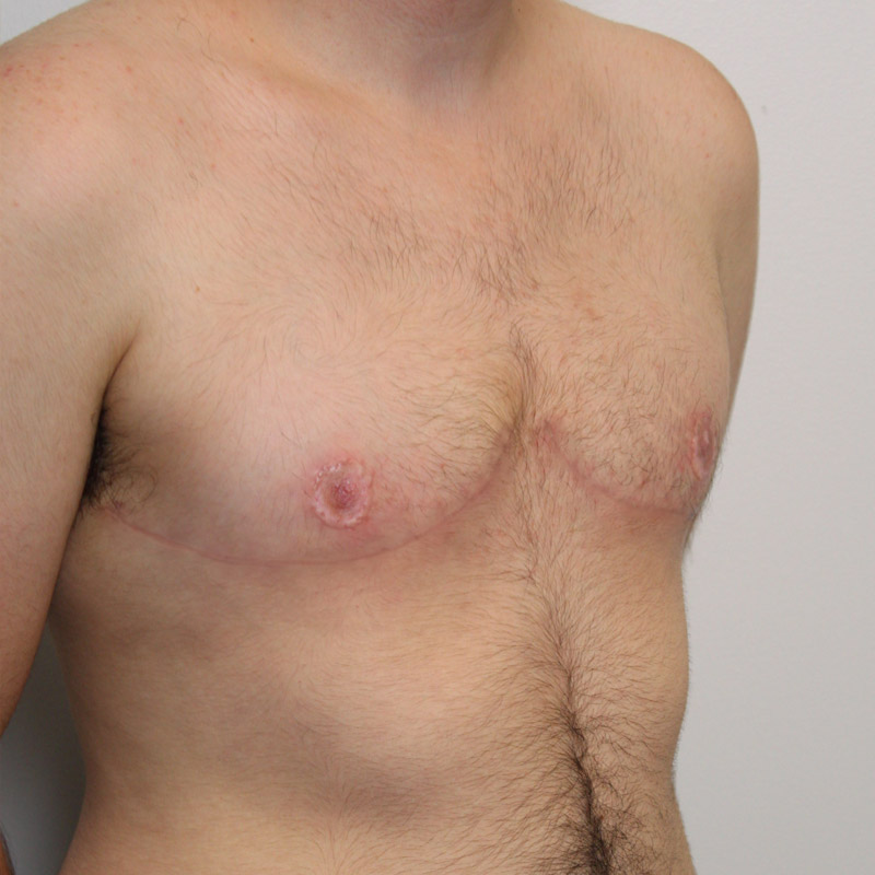 Female To Male Top Surgery 03