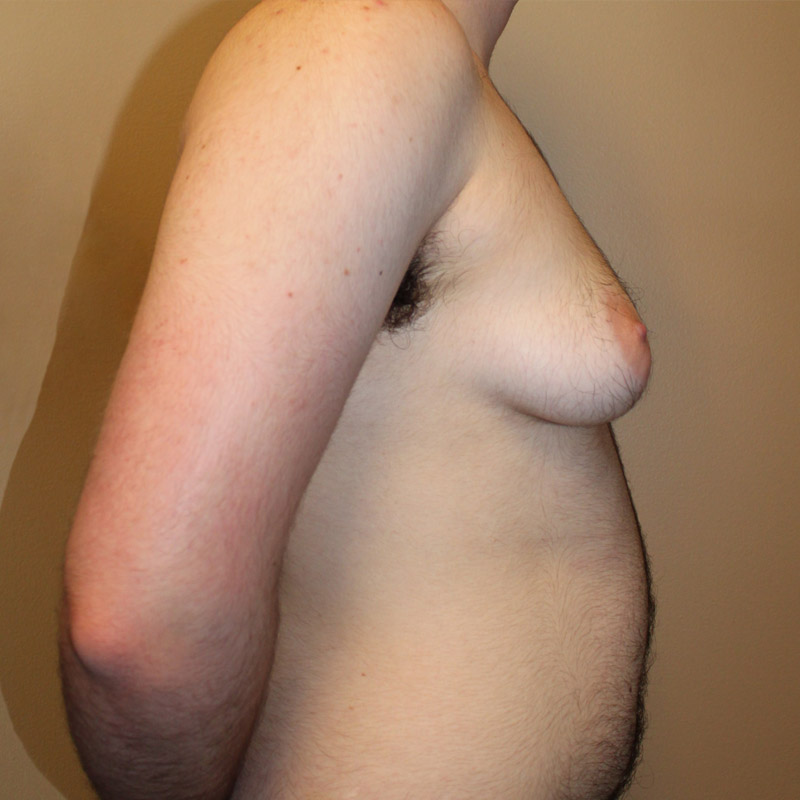 Female To Male Top Surgery 05