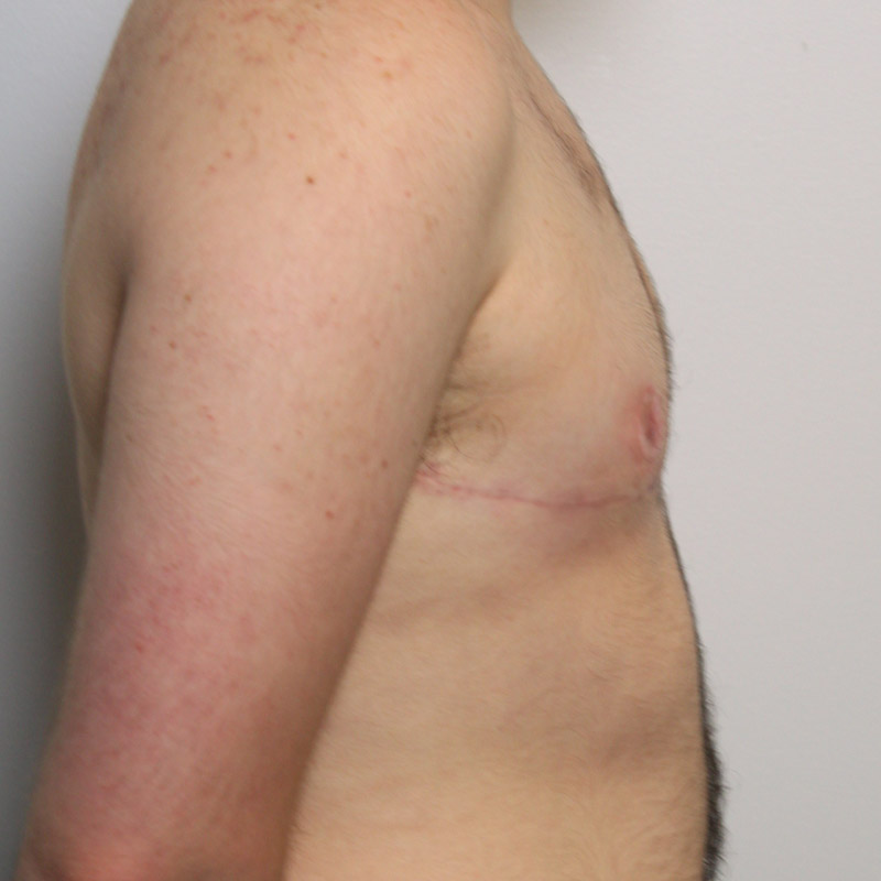 Female To Male Top Surgery 05