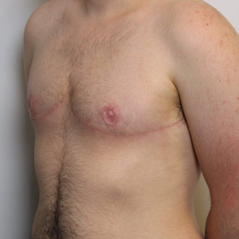 Female To Male Top Surgery 09