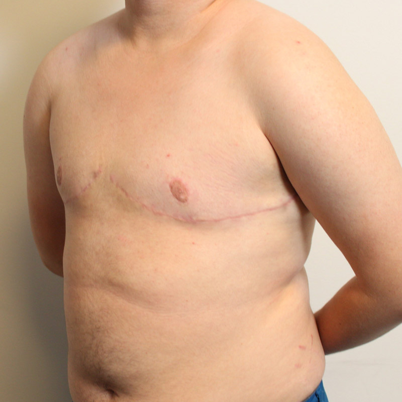 Female To Male Top Surgery 03
