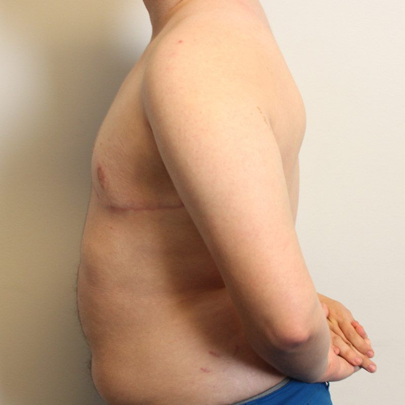 Female To Male Top Surgery 05