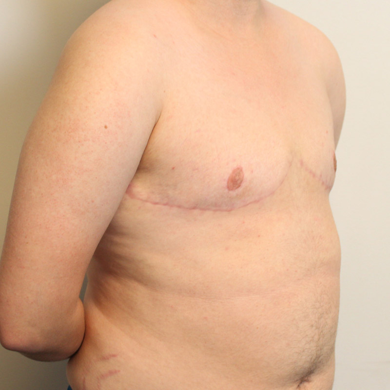 Female To Male Top Surgery 07