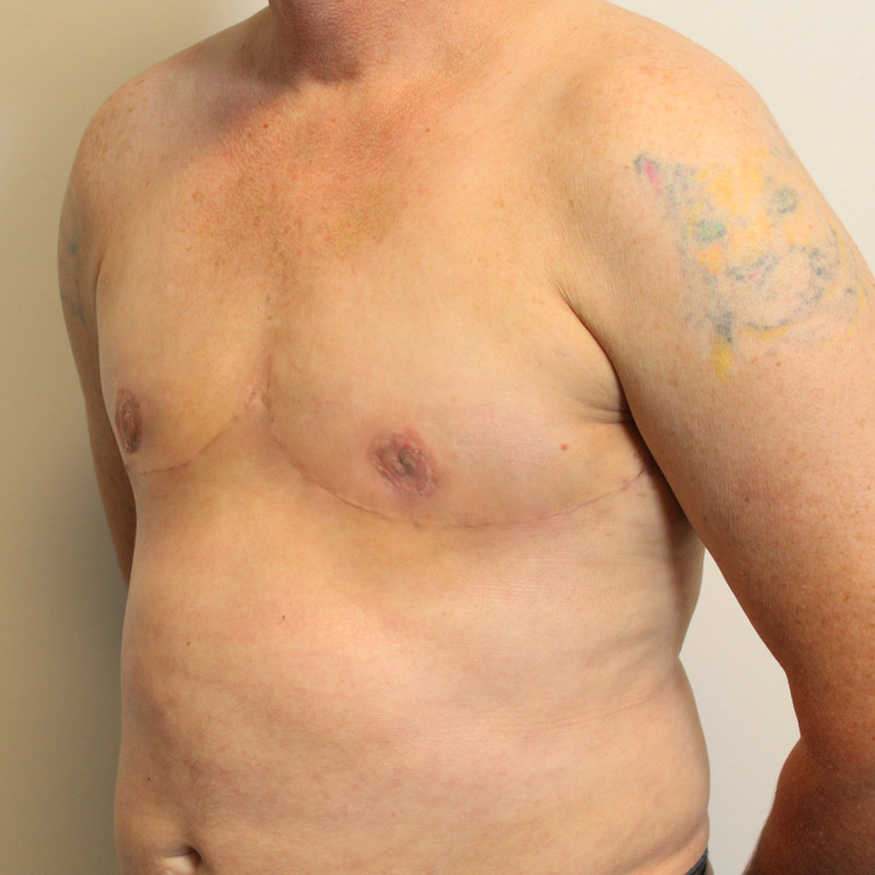 Female To Male Top Surgery 03