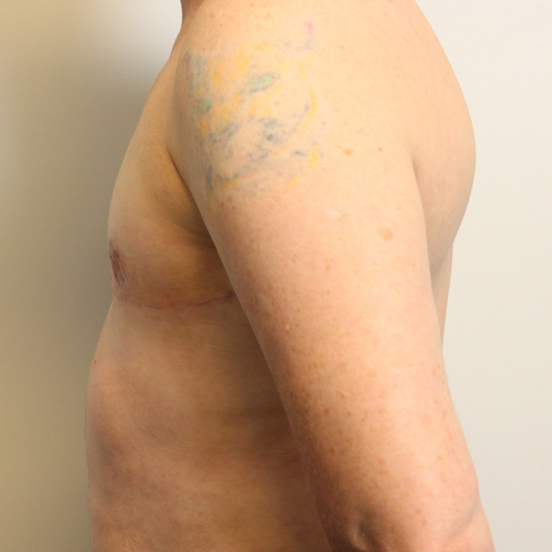 Female To Male Top Surgery 05