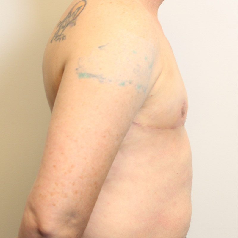 Female To Male Top Surgery 09