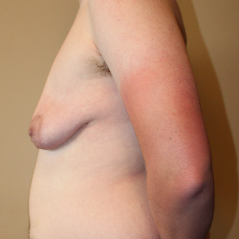 Female To Male Top Surgery 09