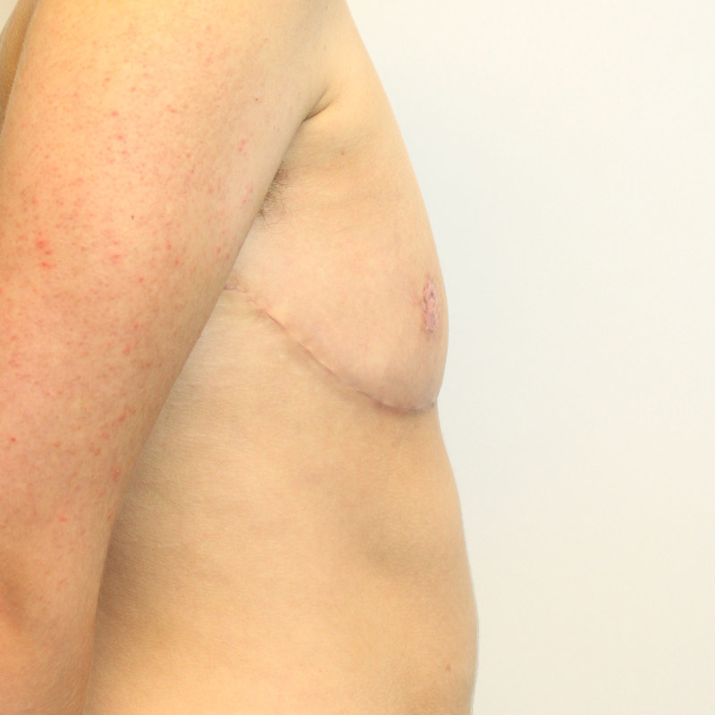 Female To Male Top Surgery 07