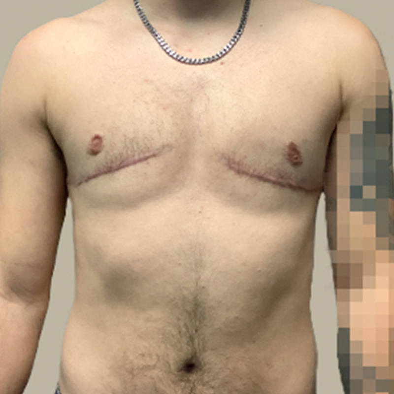 Female To Male Top Surgery 43