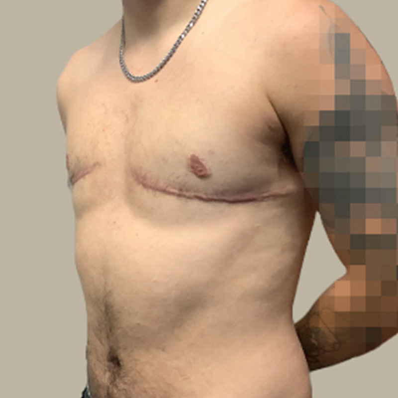 Female To Male Top Surgery 03