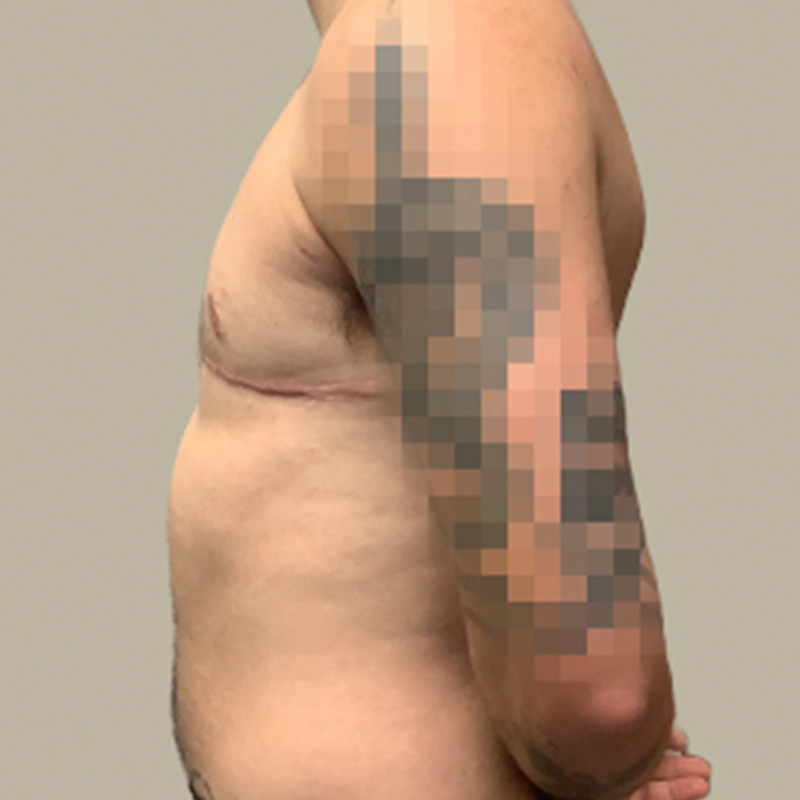 Female To Male Top Surgery 05