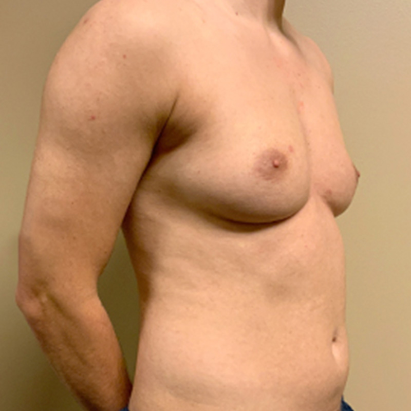 Female To Male Top Surgery 07