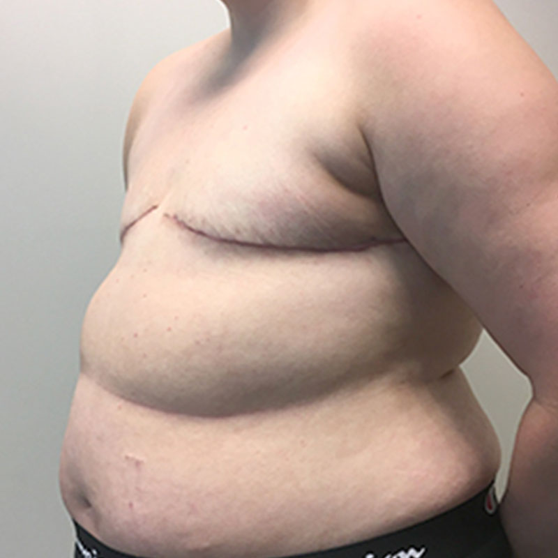 Female To Male Top Surgery 03