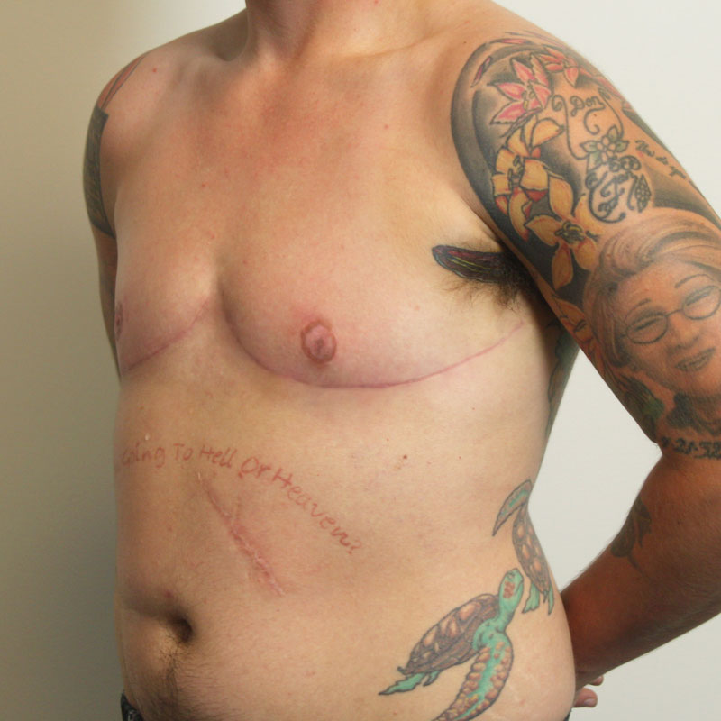 Female To Male Top Surgery 03