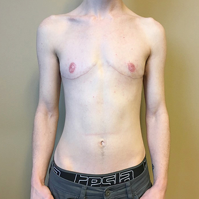 Female To Male Top Surgery 46