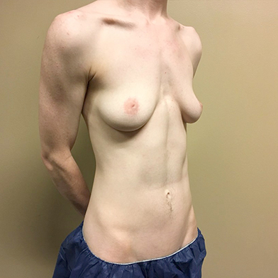 Female To Male Top Surgery 03