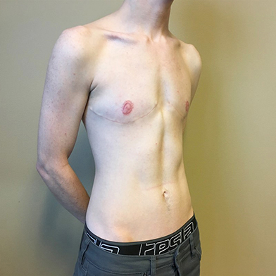 Female To Male Top Surgery 03