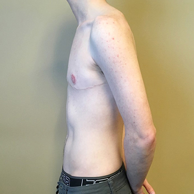 Female To Male Top Surgery 09