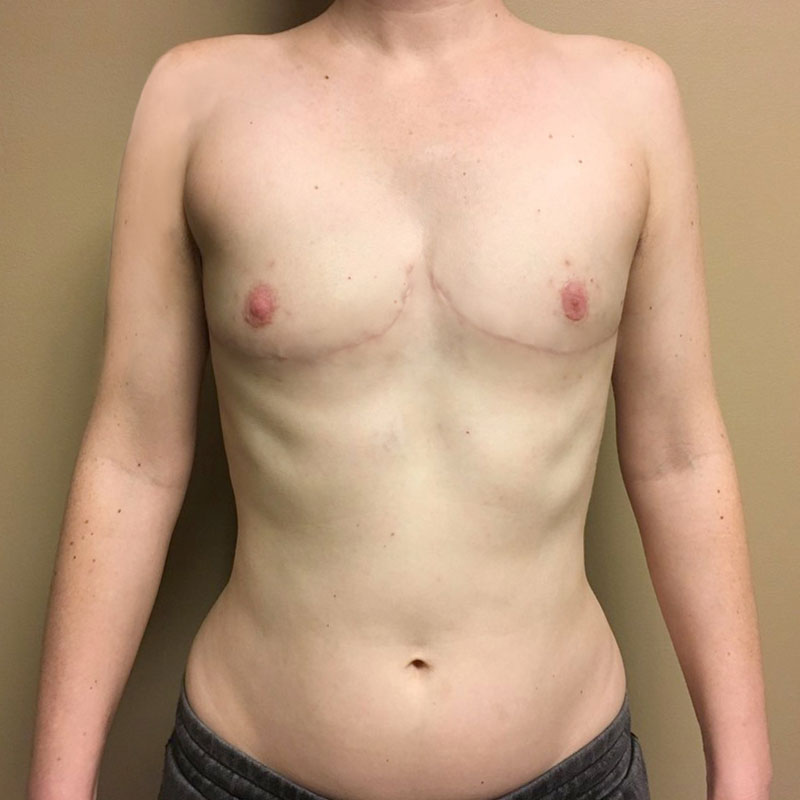 Female To Male Top Surgery 47