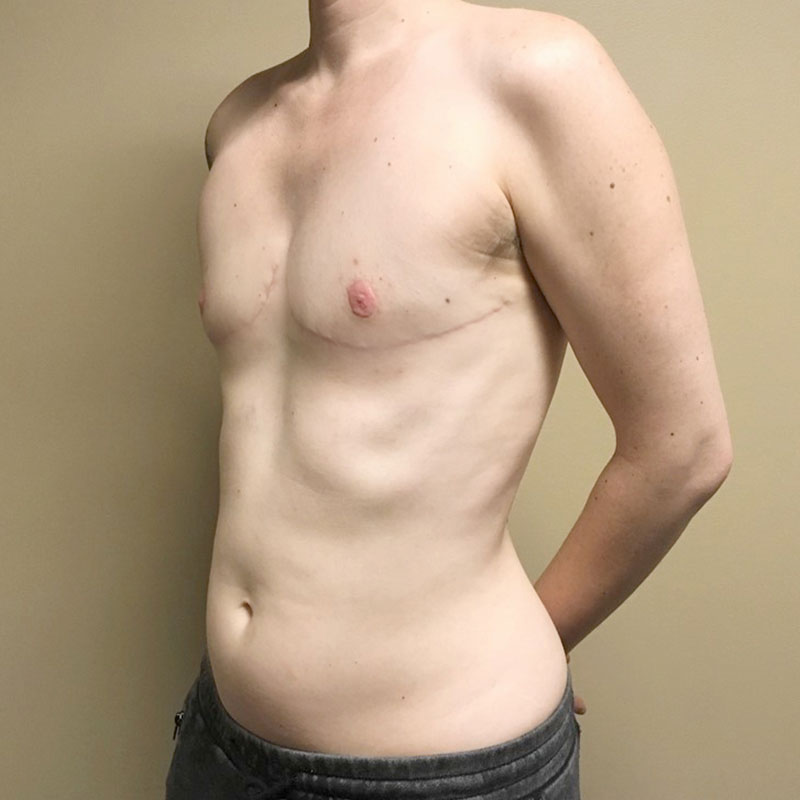 Female To Male Top Surgery 05