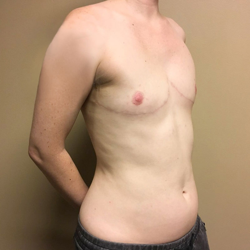 Female To Male Top Surgery 07