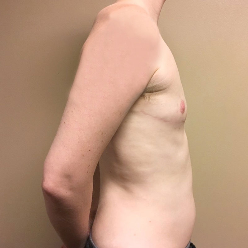 Female To Male Top Surgery 09