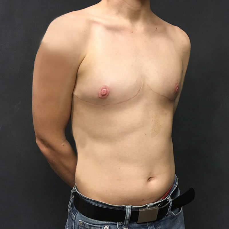 Female To Male Top Surgery 05