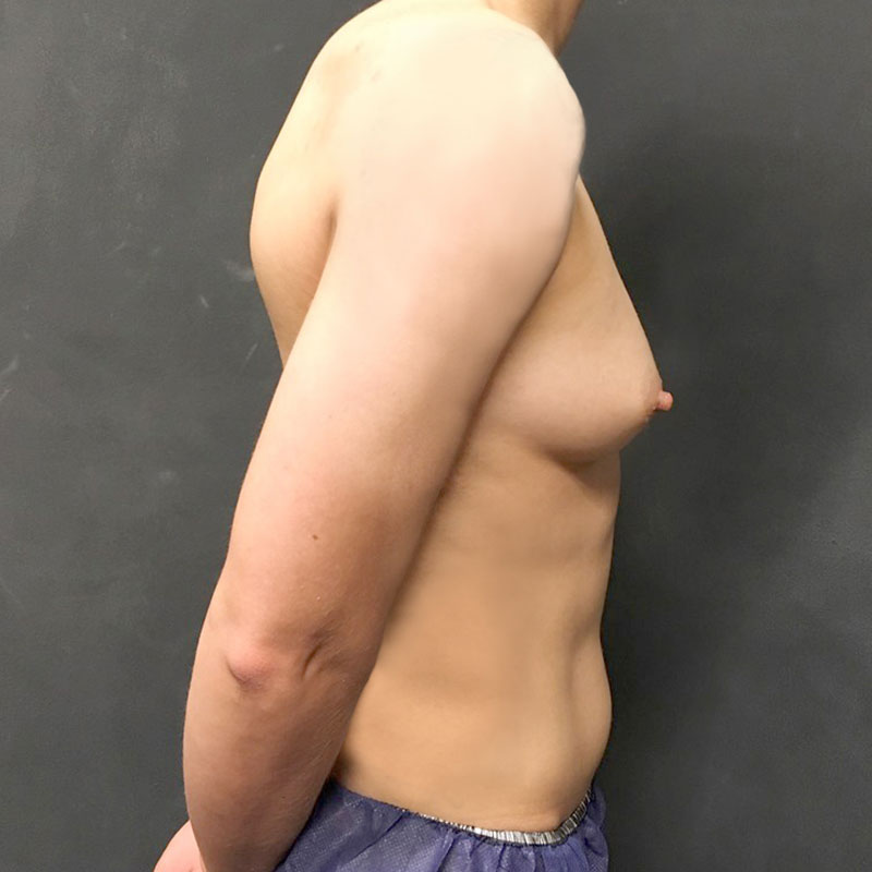 Female To Male Top Surgery 07