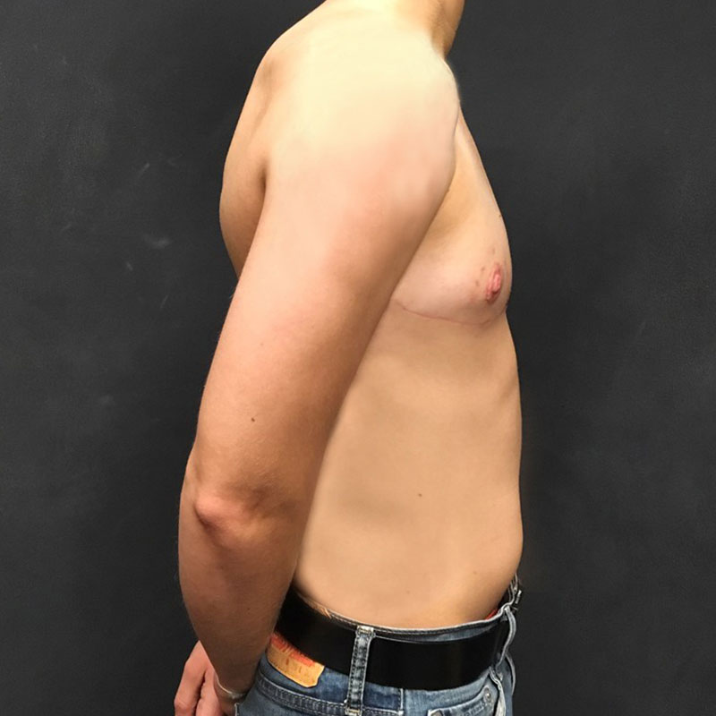 Female To Male Top Surgery 07