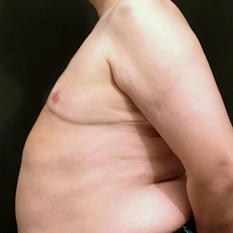 Female To Male Top Surgery 03