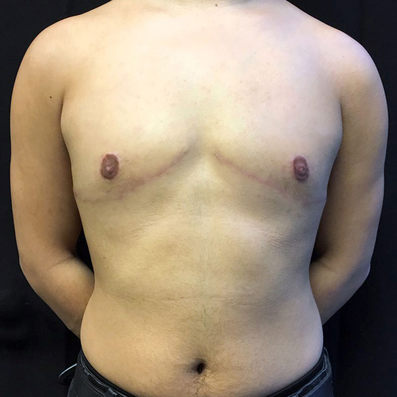 Female To Male Top Surgery 50