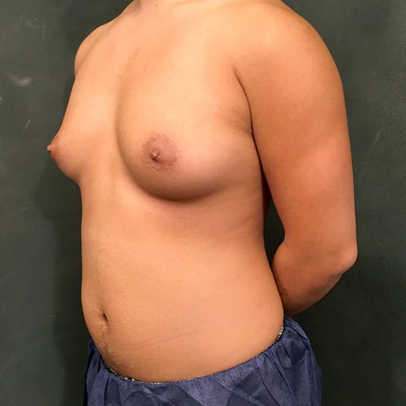 Female To Male Top Surgery 03