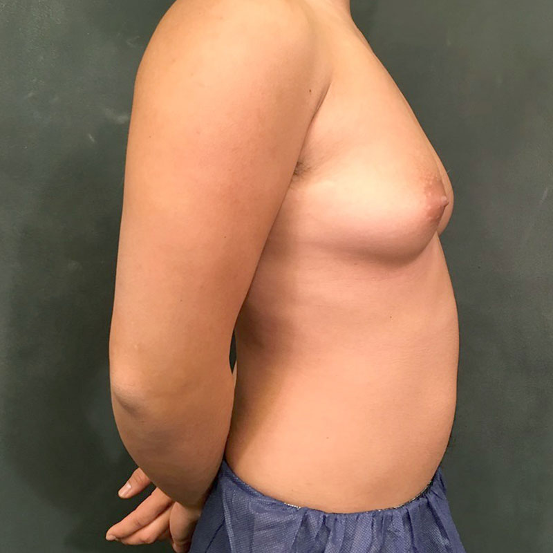 Female To Male Top Surgery 07