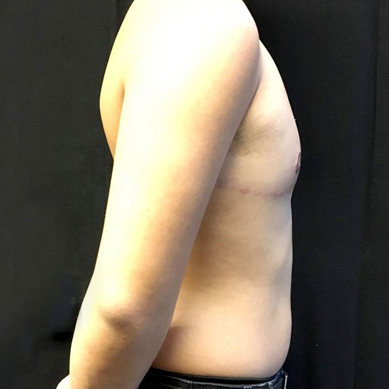 Female To Male Top Surgery 07