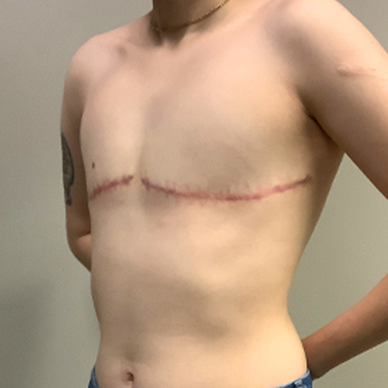 Female To Male Top Surgery 03