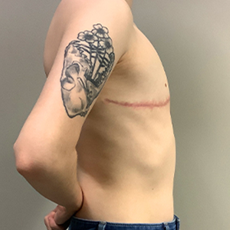 Female To Male Top Surgery 09