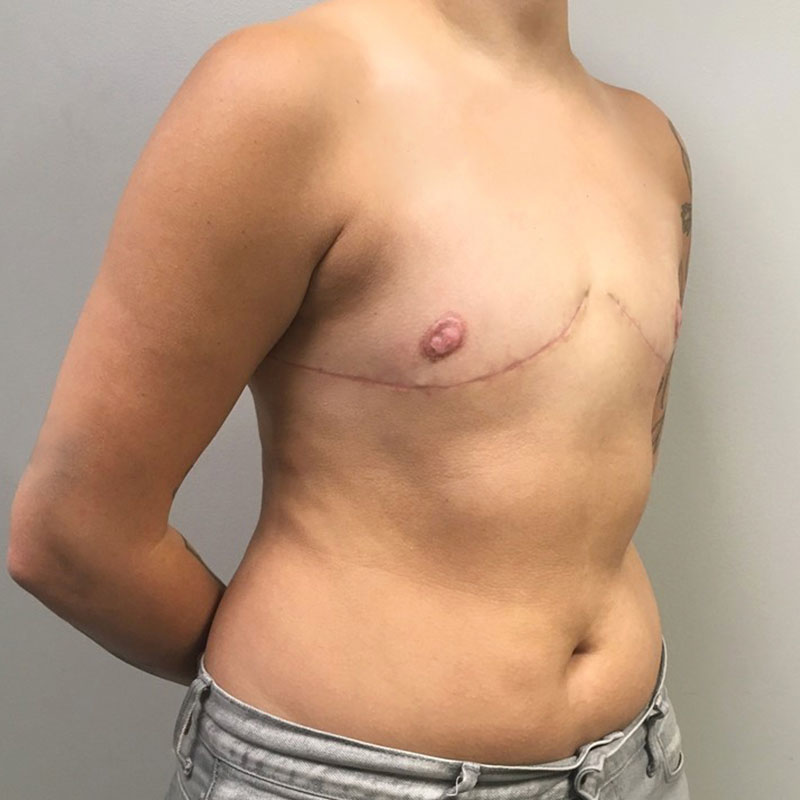 Female To Male Top Surgery 05