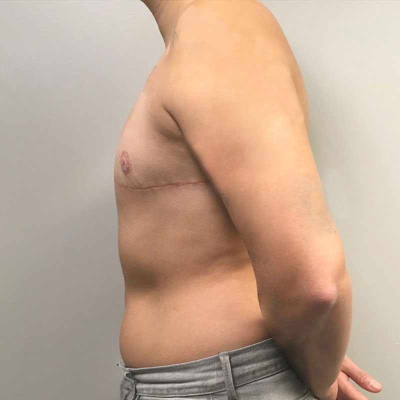 Female To Male Top Surgery 07