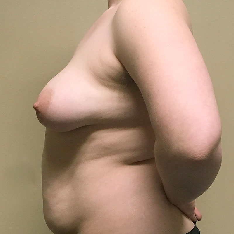 Female To Male Top Surgery 05