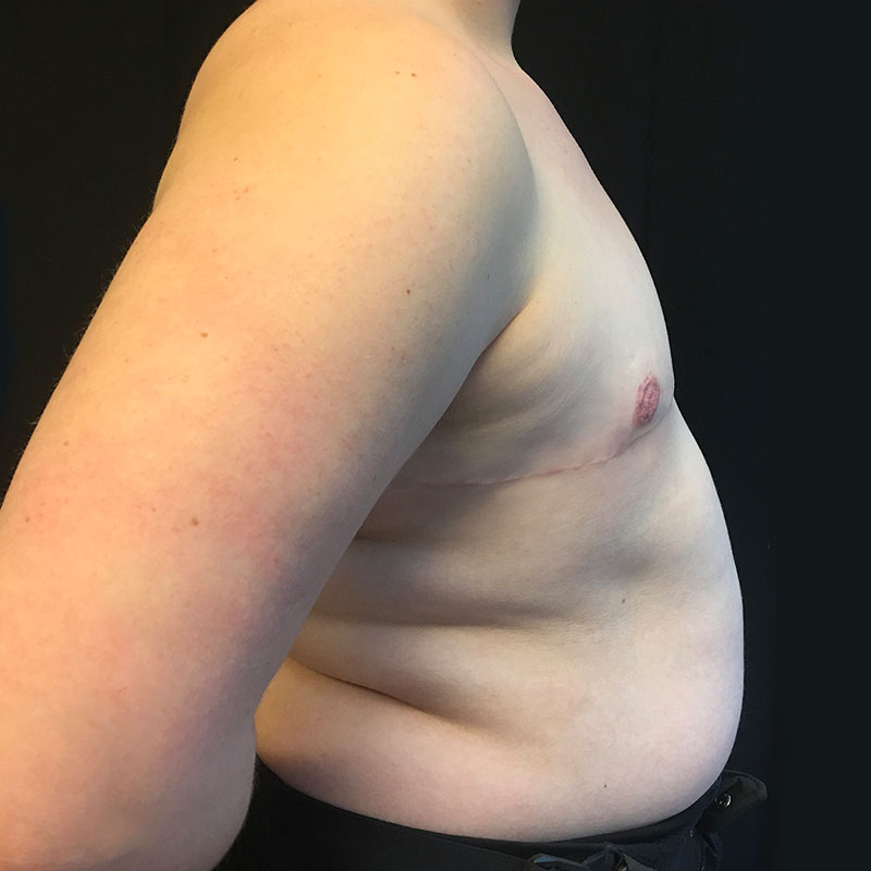 Female To Male Top Surgery 07