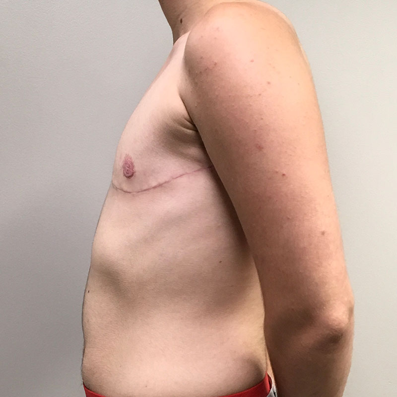 Female To Male Top Surgery 05