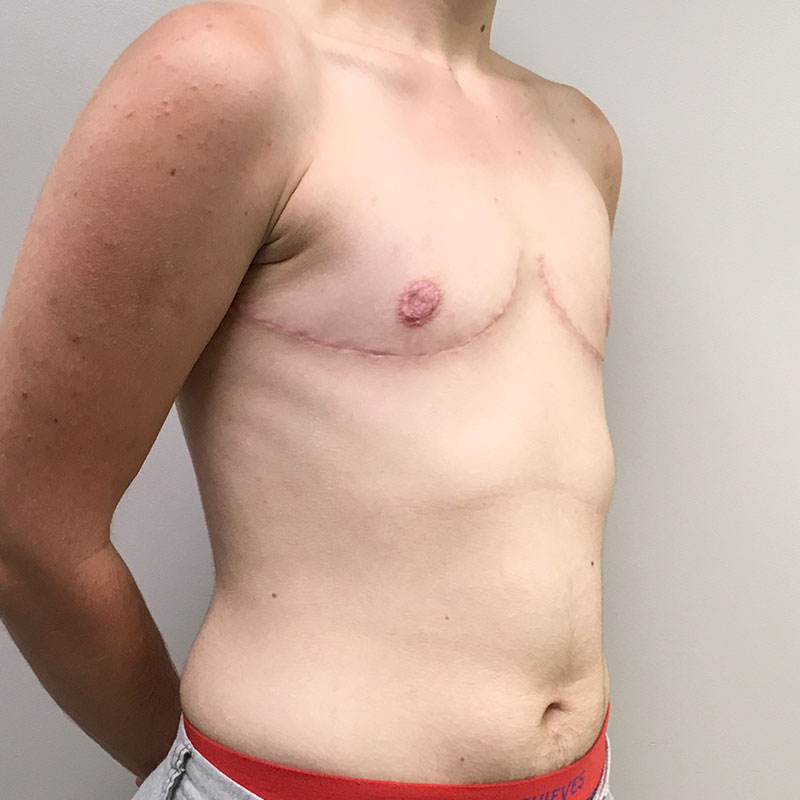 Female To Male Top Surgery 07